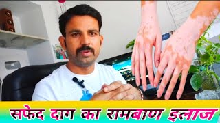 Vitiligo Vlogger मेरा सफेद दाग हुआ बिल्कुल ठीक [upl. by Randy]