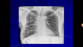 Suppurative Lung Diseases  Chest Medicine  5th grade  by Dr Manal Ahmed ElKhawaga [upl. by Yesor]