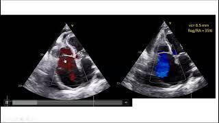 echo conference 2662024 endomyocardial fibrosis [upl. by Marba]