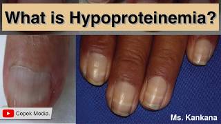 What is Hypoproteinemia [upl. by Namlas]