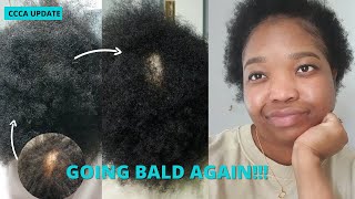 CCCA ALOPECIA HAIR UPDATE  LOSING MY HAIR AGAIN  HAIR LOSS JOURNEY [upl. by Ramey974]