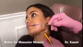 Botox for Masseter Muscle [upl. by Nallad]