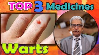 Top 3  Homeopathy Medicines for Warts  Dr PS Tiwari [upl. by Kloman779]