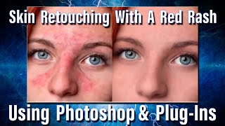 Retouching skin with a bad rash in Adobe Photoshop [upl. by Gerianna572]