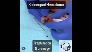 Subungual Hematoma Trephination [upl. by Baalman]