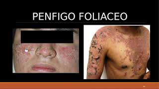 DERMATO  TEO 12 Enfermedades Ampollares [upl. by Heddy]