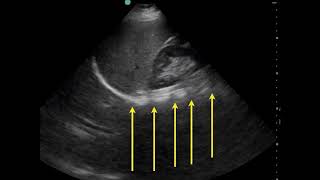 Pleural Effusion Ultrasound [upl. by Karlin]