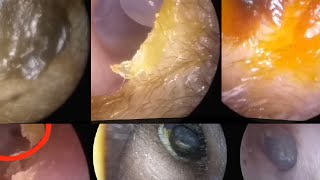 ULTIMATE EAR CLEANING COMPILATION 2024 [upl. by Paryavi]