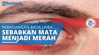 Uveitis Peradangan pada Uvea atau Lapisan Tengah Mata Ditandai Satu atau Kedua Mata Terlihat Merah [upl. by Iolanthe]