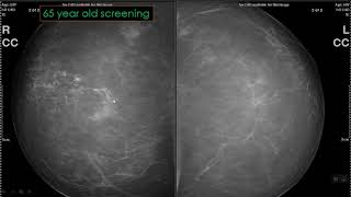 Approach to Calcifications on Mammography [upl. by Cannell]