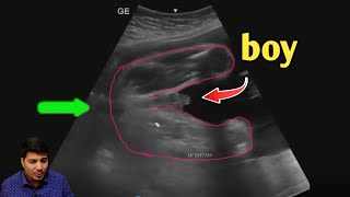 baby boy ultrasound ultrasound report boy or girl in hindi  symptoms of baby boy [upl. by Nosnevets]