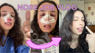 NOSE JOB and DEVIATED SEPTUM VLOG my septorhinoplasty recovery  tips [upl. by Sibyls]