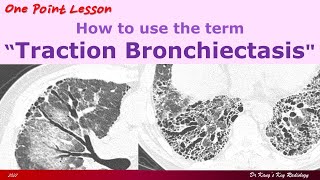 Traction Bronchiectasis [upl. by Kinsley]