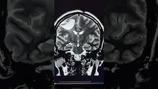 Wallerian degeneration of Corticospinal tract [upl. by Garvin135]