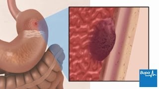 How a peptic ulcer develops  Bupa Health [upl. by Nylessej]