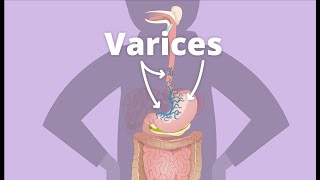 Cirrhosis – Varices [upl. by Brottman]