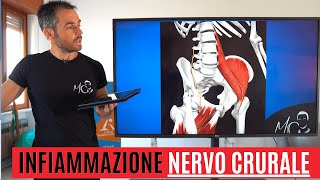 Infiammazione NERVO CRURALE una causa di dolore anteriore alla coscia [upl. by Ruffina991]