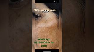 Melasma treatment melasma viralshort hyperpigmentation [upl. by Anits]