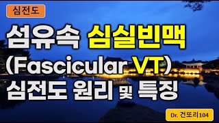 섬유속 심실빈맥fascicular VT fascicular ventricular tachycardia 심전도ecg 이해 [upl. by Lindell]