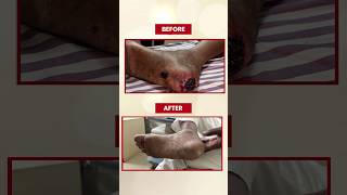 See the Amazing Transformation Before amp After Angioplasty Blood Flow Angioplasty angioplasty [upl. by Alleacim]