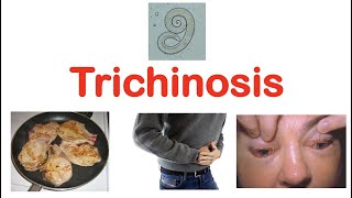 Trichinosis Pork Parasite  Pathophysiology Signs amp Symptoms Diagnosis Treatment [upl. by Darryl]