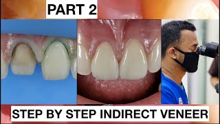 Step by Step 2 Indirect Veneer with Discoloration Tooth Part 2  General Dentist Griya RR [upl. by Odradlig158]