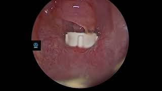 FB with Iatrogenic pharyngeal pouch [upl. by Thelma]