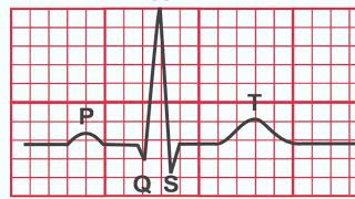 Normal EKG vs Heart Attack [upl. by Ytrebil]