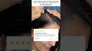 Rolling to Regrowth  Honest Reviews of Hair Serum RollOns HairgrowthReviews RollOnSerum [upl. by Enelec]