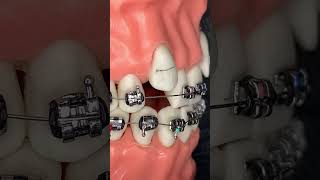 🔥Bajando colmillos con brackets de metal🔥 [upl. by Notlrak]