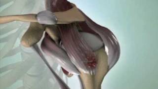 Torn Rotator Cuff Causes Symptoms amp Treatment  DePuy Videos [upl. by Franni]