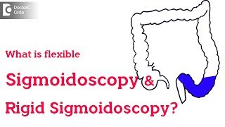 Rigid vs Flexible Sigmoidoscopy  Dr Rajasekhar M R [upl. by Kolva264]