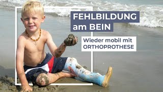 Dysmelieangeborene Fehlbildung  Versorgung mit Orthoprothesen [upl. by Yssirk431]