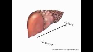 Minivideo What is cirrhosis [upl. by Nadya]