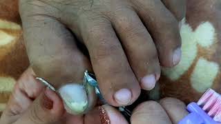 Ingrown Toenail Removal  Dry Skin  Pedicure132 [upl. by Gillett664]