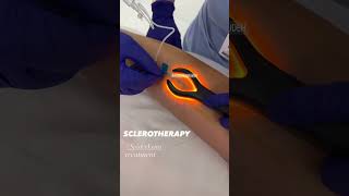 Instant Results with Sclerotherapy for Spider Veins  EDEN AESTHETICS Clinic Dubai [upl. by Enihpled426]