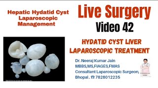 Large Hydatid cyst liver Management Laparoscopic PAIR DEROOFING hydatid cyst echinococcus liver [upl. by Skeie]