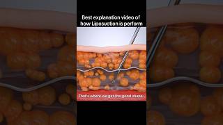 Best Explanation Video of How Liposuction Is Performed liposuction drwilliammiami ogeerecovery [upl. by Akirehs544]