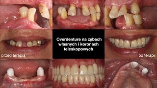 Overdenture na zębach własnych i koronach teleskopowych [upl. by Lebatsirc]