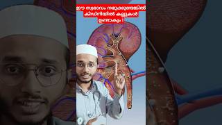 Kidney stone formation Dr Muhammed Shibili healthtips [upl. by Emia]