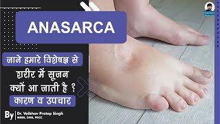 What is Anasarca   Causes Symptoms and Treatment  शरीर में सूजन क्यों आ जाती है [upl. by Htebizile]