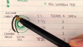 Gonioscopy Anterior chamber assessment [upl. by Deer]