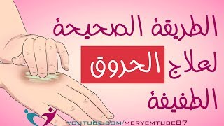 الطريقة الصحيحة لعلاج الحروق في المنزل [upl. by Sirronal694]