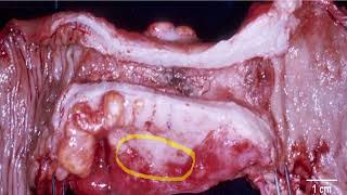 COLON ADENOCARCINOMA [upl. by Erastatus]