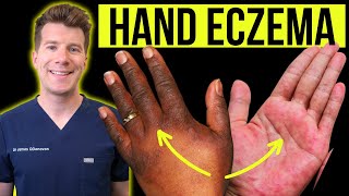 Doctor explains how to recognise and treat HAND ECZEMA dermatitis  Causes symptoms amp prevention [upl. by Anorahs]