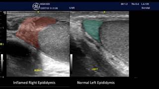 Acute Epididymitis  some PointofCare Ultrasound Features [upl. by Annavoeg]