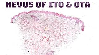 Nevus of Ito Ota Sun Hori amp Dermal Melanocytosis quotMongolian Spotquot under the microscope dermpath [upl. by Eladnwahs]