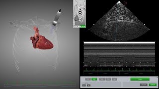 HeartWorks Pneumothorax [upl. by Ahsaek614]