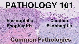 Eosinophilic Esophagitis amp Candida Esophagitis  Pathology 101 GI Pathology [upl. by Tews85]