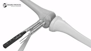 Video Operation of Pediatric Epiphyseal Plate [upl. by Odlavso]